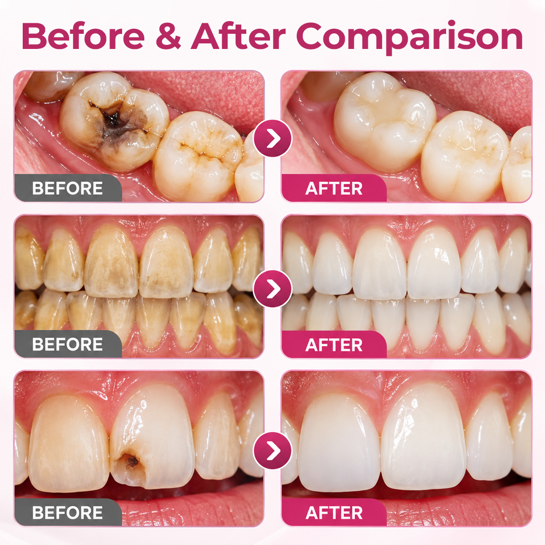 Alcuras® DenPerm Cavity-Repair Natural Enamel Filling Gel