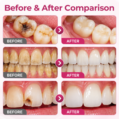Alcuras® DenPerm Cavity-Repair Natural Enamel Filling Gel